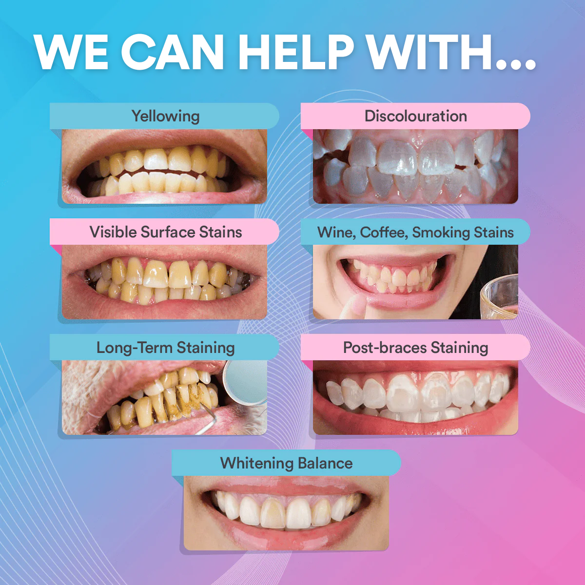 Teeth Whitening Strips